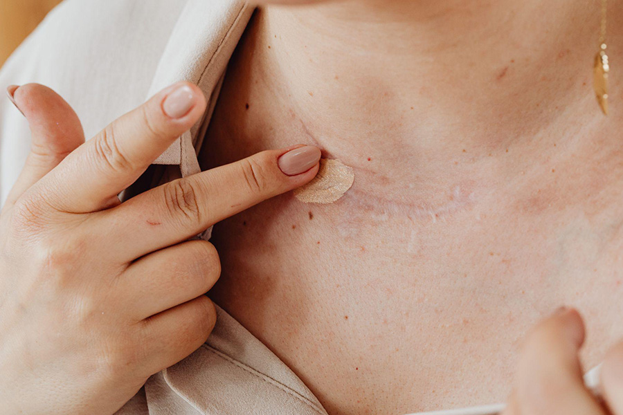 Person applying color-correcting concealer to a scarred area